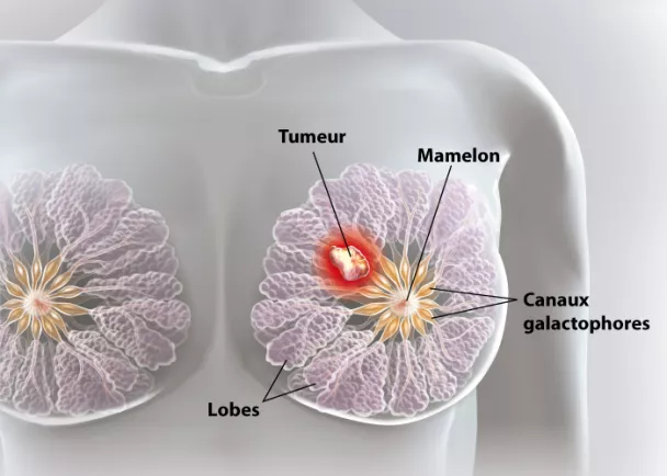 Mieux détecter le cancer du sein avec un test de salive